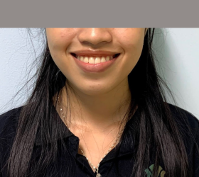 NIỀNG RĂNG MẮC CÀI KIM LOẠI