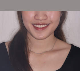 NIỀNG RĂNG MẮC CÀI KIM LOẠI