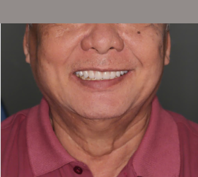 CẤY GHÉP IMPLANT TOÀN HÀM