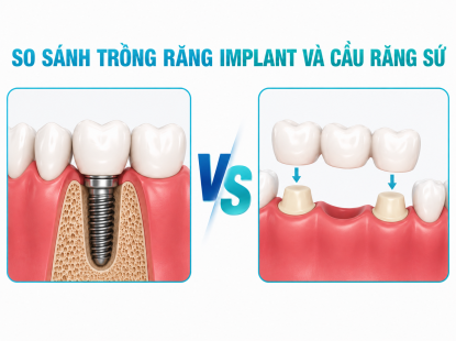 SO S&Aacute;NH PHƯƠNG PH&Aacute;P TRỒNG RĂNG IMPLANT V&Agrave; CẦU RĂNG SỨ. Đ&Acirc;U L&Agrave; LỰA CHỌN TỐI ƯU KHI MẤT RĂNG?