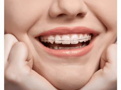 NIỀNG RĂNG MẮC CÀI SỨ