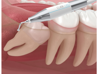 NHỔ RĂNG BẰNG MÁY SIÊU ÂM PIEZOTOM