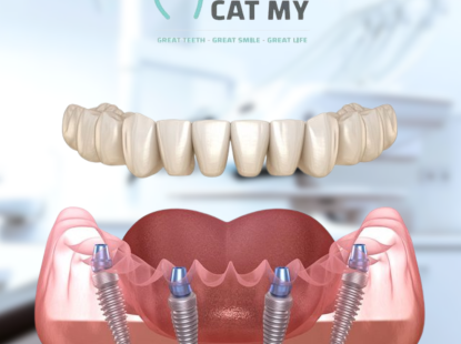 Cấy ghép Implant toàn hàm 