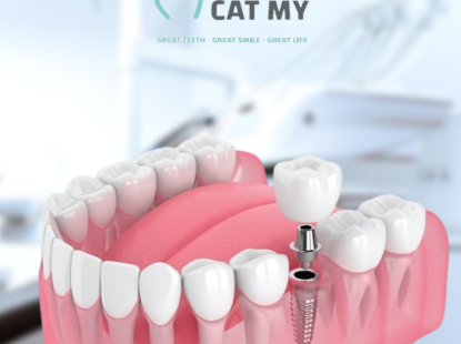 CẤY GHÉP IMPLANT NHA KHOA