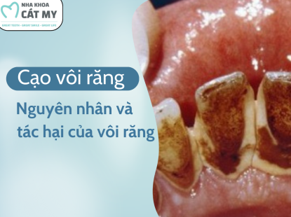 VÔI RĂNG - NGUYÊN NHÂN VÀ TÁC HẠI CỦA VÔI RĂNG