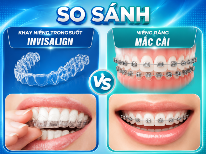 So S&aacute;nh Niềng Răng Invisalign V&agrave; Niềng Răng Mắc C&agrave;i