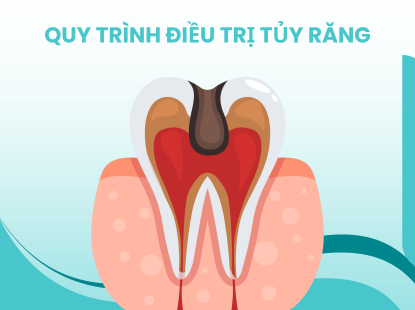 QUY TR&Igrave;NH ĐIỀU TRỊ TỦY RĂNG