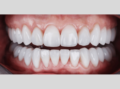 BỌC RĂNG SỨ THẨM MỸ 