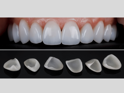 VENEER SỨ THẨM MỸ