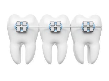 MẮC CÀI KIM LOẠI 