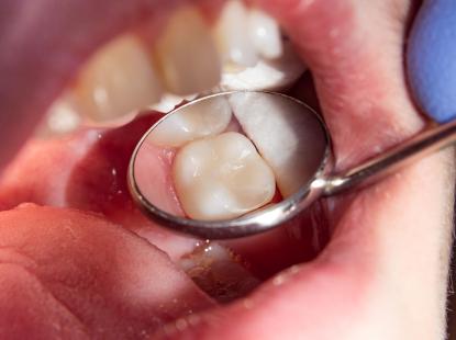 TRÁM RĂNG THẨM MỸ