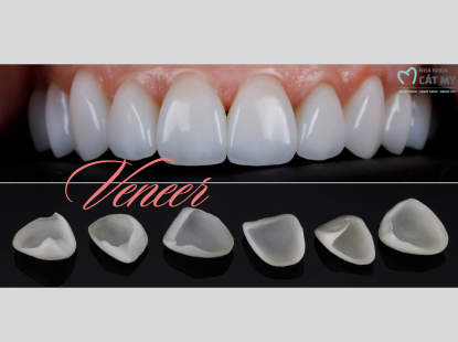Dán Răng Sứ Veneer 