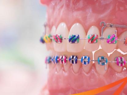 NIỀNG RĂNG MẮC CÀI KIM LOẠI