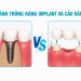 SO S&Aacute;NH PHƯƠNG PH&Aacute;P TRỒNG RĂNG IMPLANT V&Agrave; CẦU RĂNG SỨ. Đ&Acirc;U L&Agrave; LỰA CHỌN TỐI ƯU KHI MẤT RĂNG?
