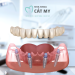 Cấy ghép Implant toàn hàm 