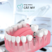 CẤY GHÉP IMPLANT NHA KHOA