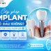 Cấy gh&eacute;p Implant c&oacute; đau kh&ocirc;ng? Giải đ&aacute;p từ chuy&ecirc;n gia