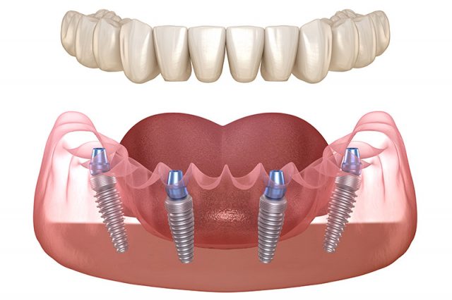 Cấy ghép Implant toàn hàm 