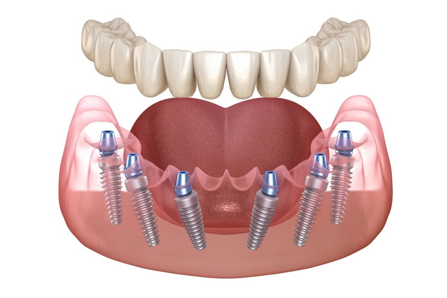 Cấy ghép Implant toàn hàm 