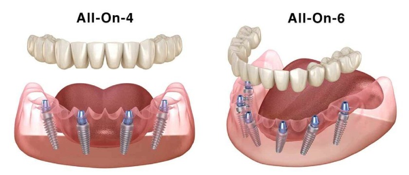 Cấy ghép Implant toàn hàm 