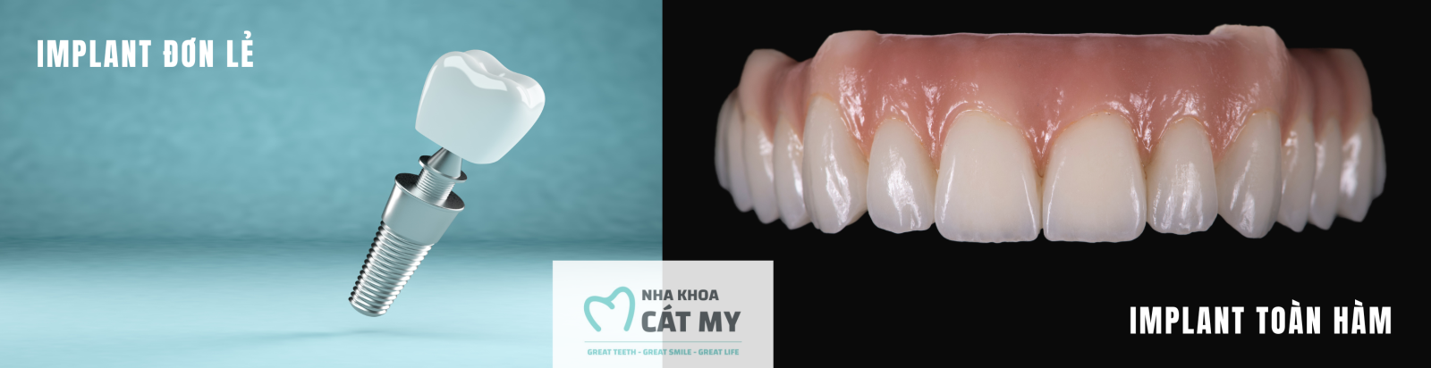 cấy ghép implant nha khoa