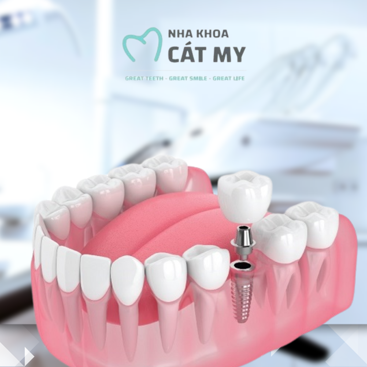 cấy ghép implant nha khoa