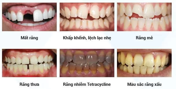 BỌC RĂNG SỨ THẨM MỸ